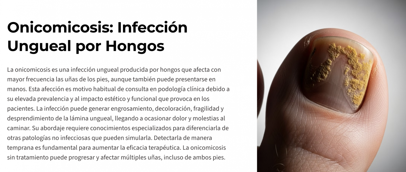 Onicomicosis